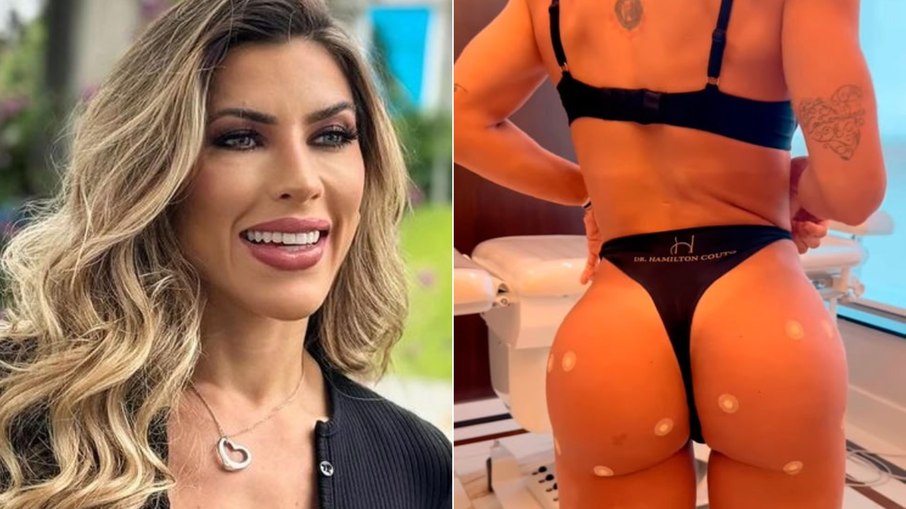 Ana Paula Minerato remove hidrogel do corpo depois complicações